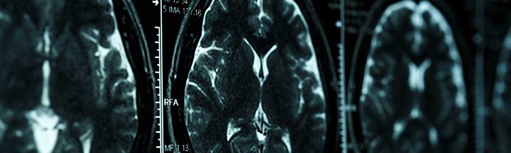 MR epectroscopic imaging may help better diagnose, treat multiple sclerosis